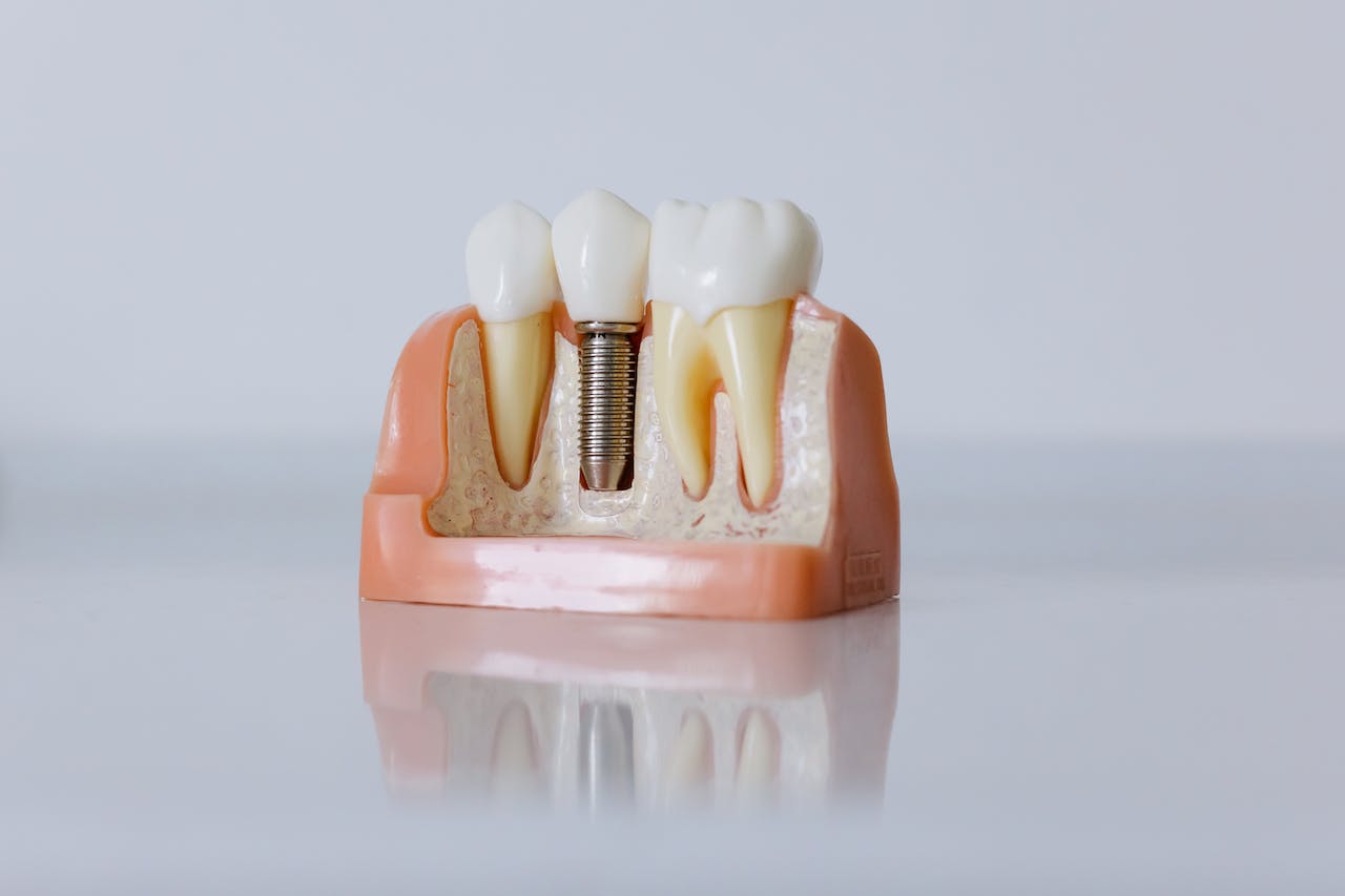 Implanty zębowe – kiedy i dlaczego warto?